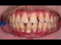 SCALING TARTAR ! | Dentist | Dokter Gigi Tri Putra