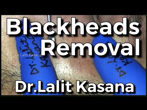BLACKHEADS REMOVAL BY DR LALIT KASANA