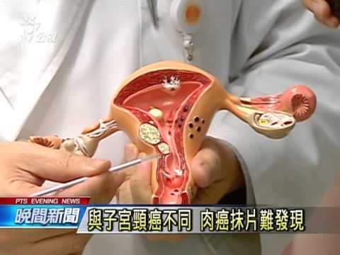 子宮體肉癌難發現晚期存活率低 公視晚間 Youtube 子宮體肉癌難發現晚期存活率低 公視晚間 Youtube