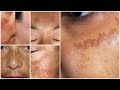 Dark Spots, Pigmentation, दाग धब्बे / (Melasma) का पूरा ईलाज | by dermatologist Dr Suman Agarwal