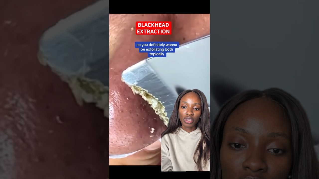 Chemist Explains Intense BLACKHEAD REMOVAL plus Treatment