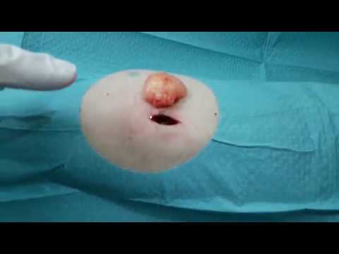 Surgical removal of lipoma with lipomatosis on the arm