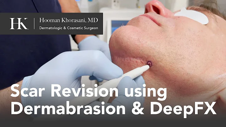 How To Remove a Scar on your Chin | Dr. Hooman Khorasani