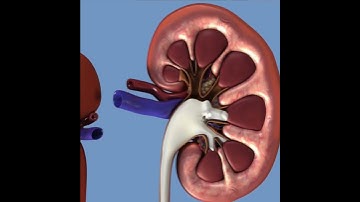 Retrograde Pyelogram