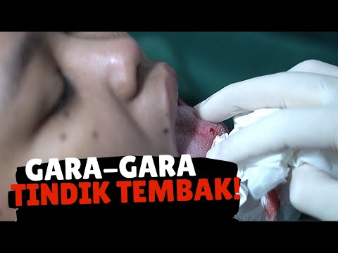 Anting Tertanam di Lidah Karena Tindik Tembak - Say NO to Piercing Guns - Tindik Murah Jadi Masalah