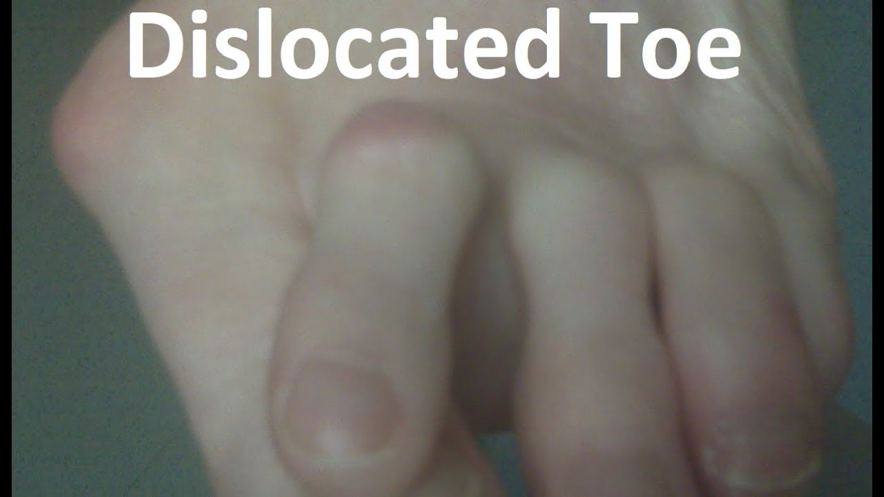 Dislocated Toe Pain *Home Treatment Guide*