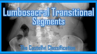 Lumbosacral Transitional Segments - LSTV #anatomy #radiology #medical