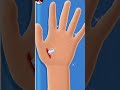 Doctor Surgery Game Hand Surgery Android Gameplay 