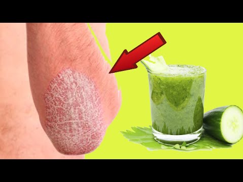 Vídeo: 8 Consejos Para Encontrar El Dermatólogo Adecuado Para La Psoriasis