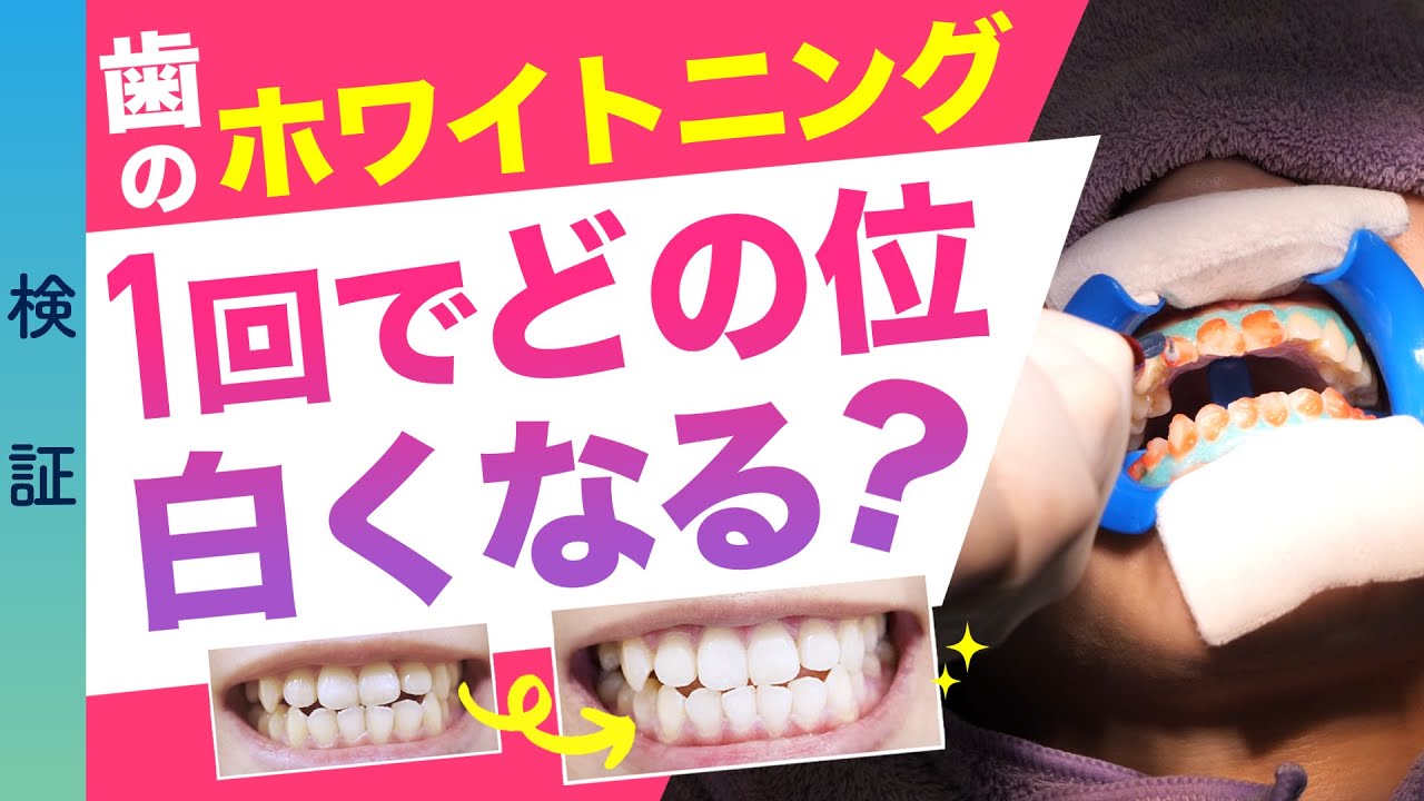 【歯科のホワイトニング】1回でどのくらい白くなる？痛い？オフィスホワイトニング＊検証＊