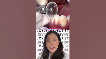 IPR (INTERPROXIMAL Reduction) using a Disc before Invisalign to create space #invisalign #shorts