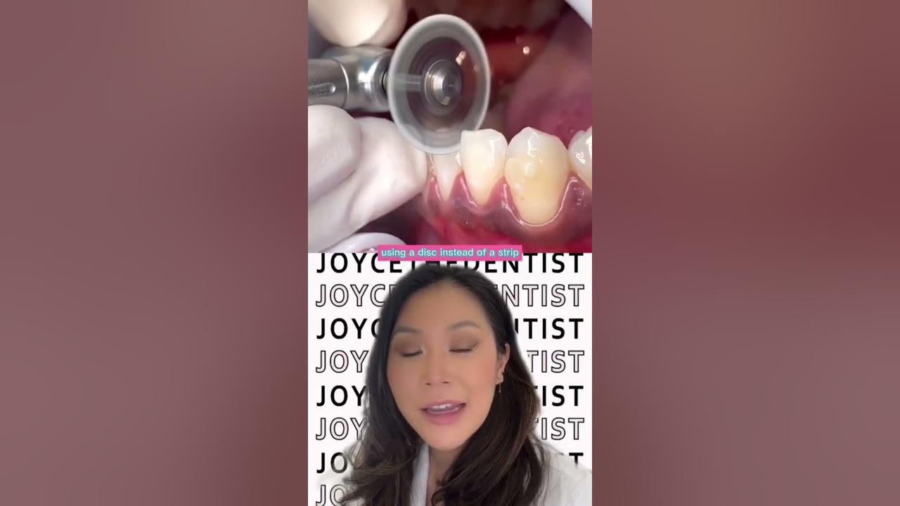 IPR (INTERPROXIMAL Reduction) using a Disc before Invisalign to create space invisalign shorts