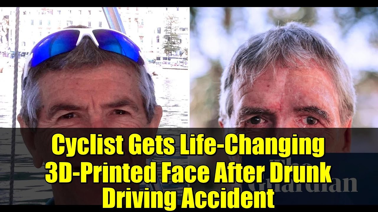 Cyclist Gets Life-Changing 3D-Printed Face After Drunk Driving Accident | Inspiring Recovery Story