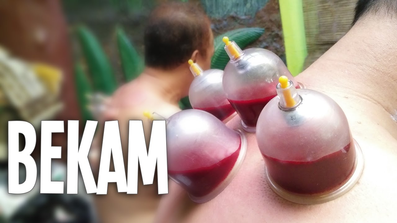 Wet Cupping Therapy (Bekam) or Hijama - How to - YouTube