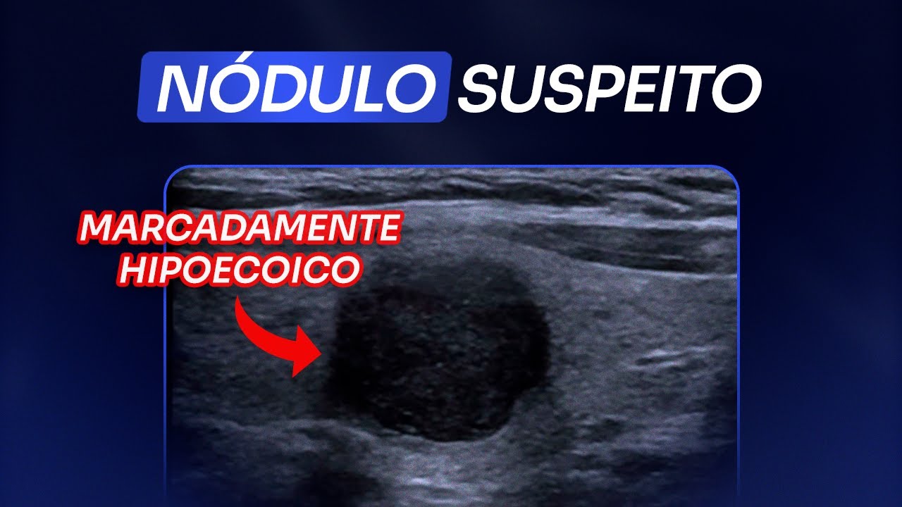 Como avaliar a ecogenicidade do nódulo de tireoide | ACR-TIRADS