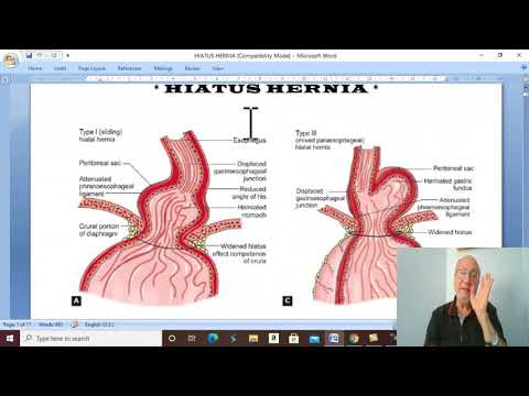 Video: Hiatal Hernia: Příčiny, Typy, Léčba, Diagnostika A Další