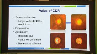 AIOC2026   IC210   T Dr Sushma Tejwani Optic Nerve Evaluation in Glaucoma  the Ddls and Masquerades