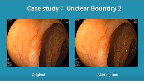 Real-Time Polyp Detection AI For Unclear Boundry Cases
