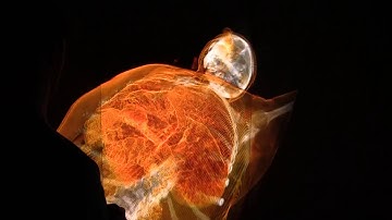 SAS 2015 - A Virtual Scalpel for Visualizing Patients in 3D