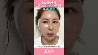 【韓国整形】切開フェイスリフトでたるみを解決して童顔に!!😊 #shorts