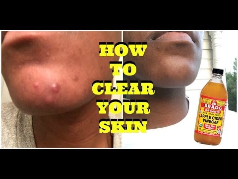 How To Clear Acne and Acne Scars With Apple Cinder Vinegar