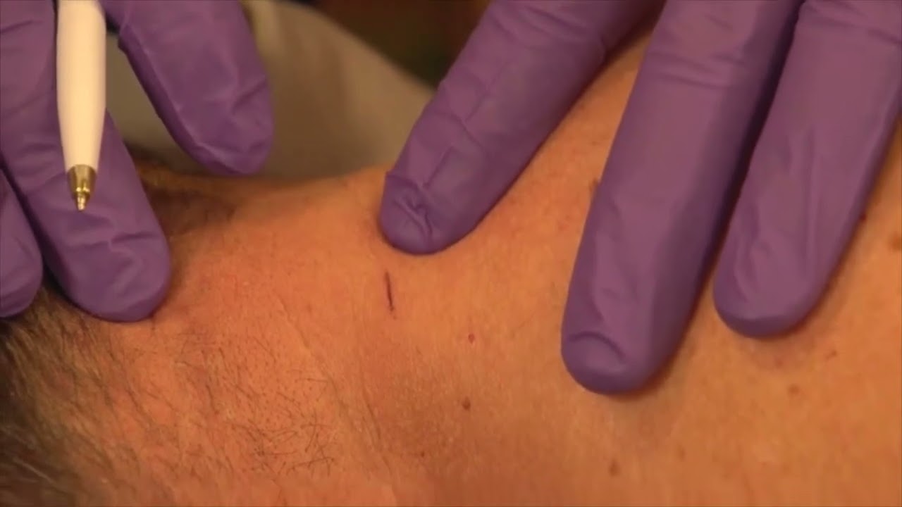 Video: Neck injection technique