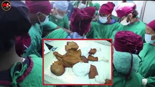 Ugumu Waliopitia Madaktari Kuwatenganisha Watoto Mapacha Walioungana Muhimbili....