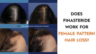 Why Finasteride is Not Usually Prescribed for Female Pattern Hair Loss