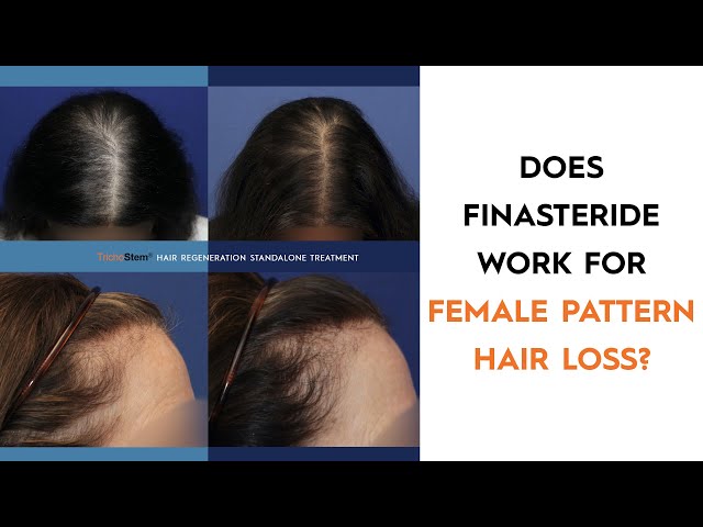 Female Pattern Baldness – Top 3 Do's and Dont's | Hair Sure