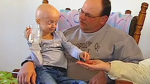 Quando si manifesta la progeria?