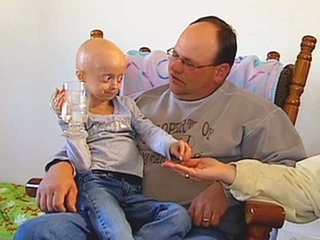 Progeria neonatal Neonatal Progeroid