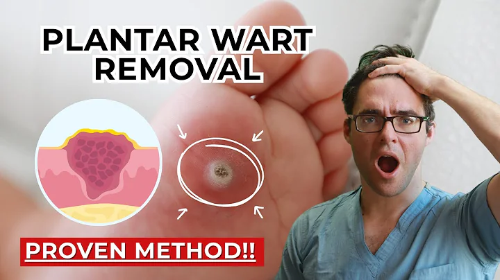How To Get Rid of the MOST STUBBORN Plantar Warts! [2024 Update]
