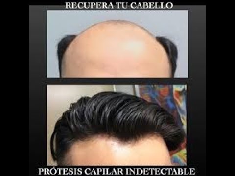 protesi capelli on line