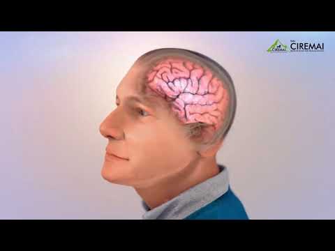 Video: Implan Otak Untuk Memori Akan Tersedia Dalam 5-10 Tahun Mendatang - Pandangan Alternatif