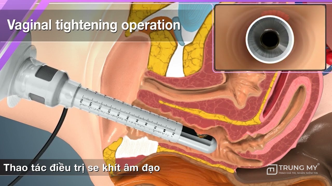 Fraxis Duo -  Laser Co2 Fractional trẻ hóa vùng kín