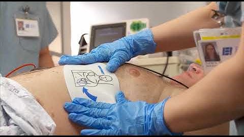 Synchronized Cardioversion with the HeartStart XL+ monitor/defibrillator