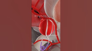 Brain Aneurysm Clipping (3D Animation)