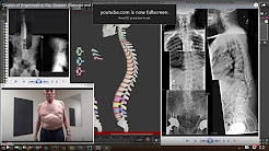 Causes of Degenerative Disc Disease, Stenosis and Arthritis