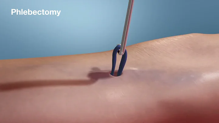 Varicose Vein Treatment Options