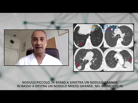 Video: Un nodulo subpleurico può essere un cancro?