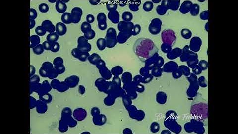 Acute  Myeloid leukemia with monocytic differentiation