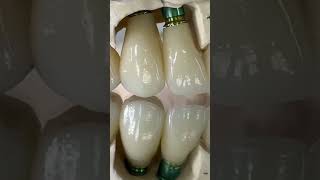 Cosmetic restorations with implants