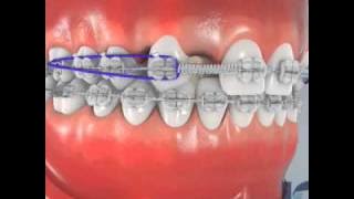 Missing Upper Laterals