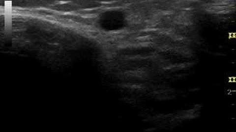 saphenous nerve scanning