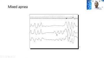 "Sleep Disorders in Neurological Practice -A Practical Perspective"-Lecture #mac2021