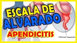 ESCALA DE ALVARADO | Apendicitis Aguda