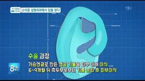 [닥터리포트]소이증, 성형외과에서 답을 찾다