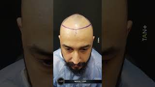 Şaşırtan Sonuç Before After Egemen Güdül 2022 Hair Clinic Ankara