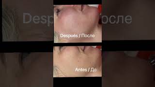 Láser Rejuvenecimiento de la piel /Лазер омоложения кожи