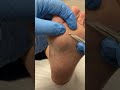 ✨ Witness the ultimate #OddlySatisfying moment as a skilled podiatrist removes a stubborn seed corn!